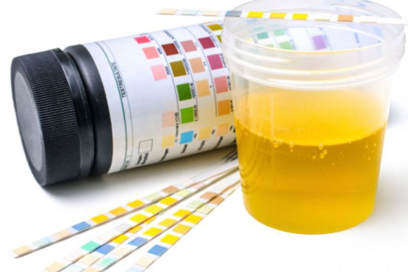 Análisis de orina para diagnóstico clínico en laboratorios médicos de España