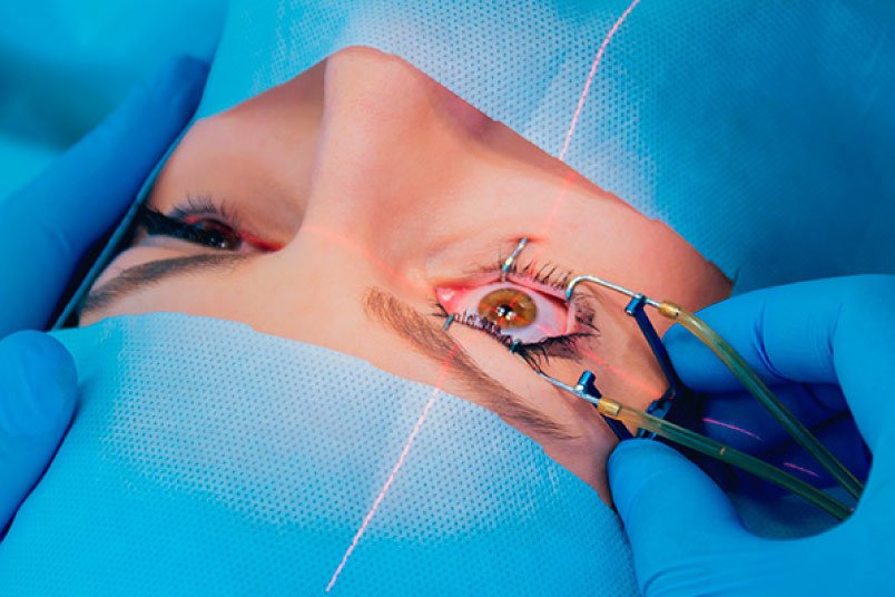 Cirugía refractiva ocular para corrección de la vista con tecnología avanzada en España