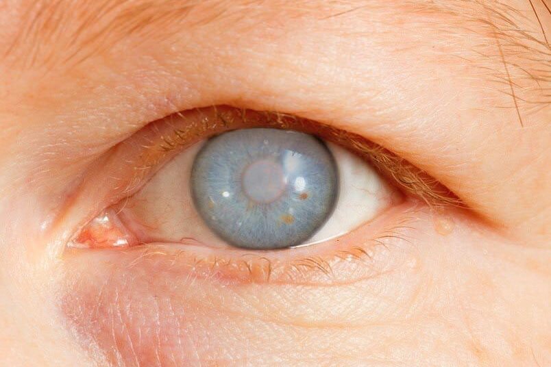 Tratamiento avanzado para glaucoma en clínicas oftalmológicas en España