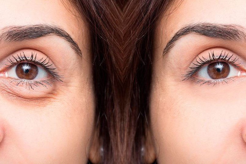 Cirugía de blefaroplastia para rejuvenecimiento ocular con Medrism en España