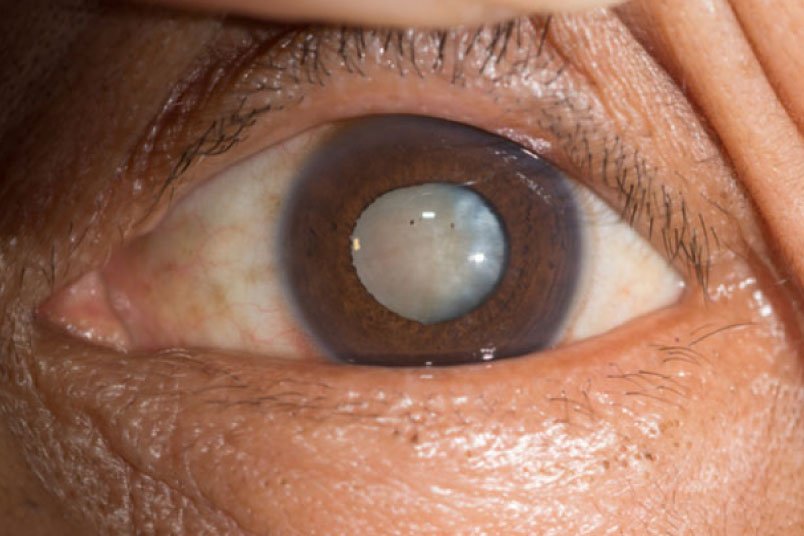 Cirugía de cataratas realizada por oftalmólogos expertos en España