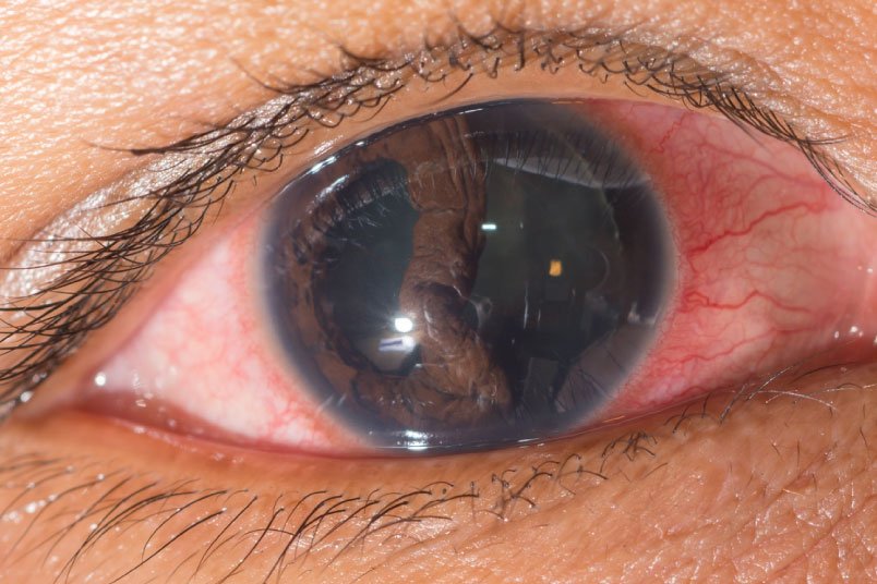 Tratamiento para desprendimiento de retina en clínicas oftalmológicas de España