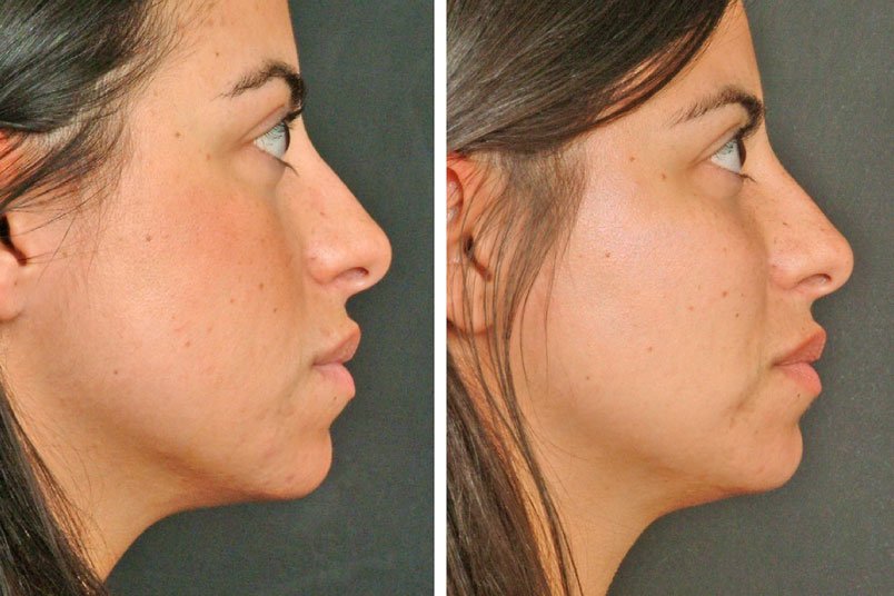 Procedimiento de lipofilling para remodelación corporal con Medrism