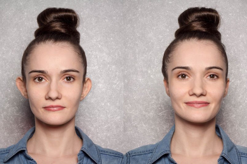 Cirugía de otoplastia para corregir orejas prominentes realizada en España