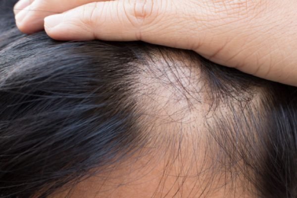 Tecnica-FUE-Follicular-Unit-Extraction