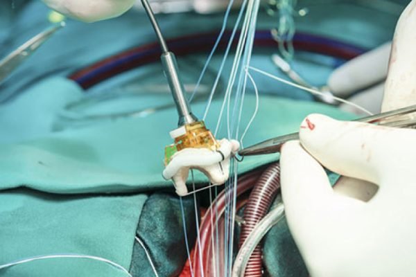 cirugia-de-la-valvula-cardiaca